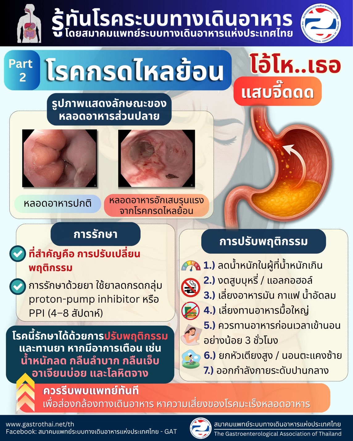 โรคกรดไหลย้อน Part 2